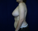 picture-breast-reconstruction-expander- 114c.jpg